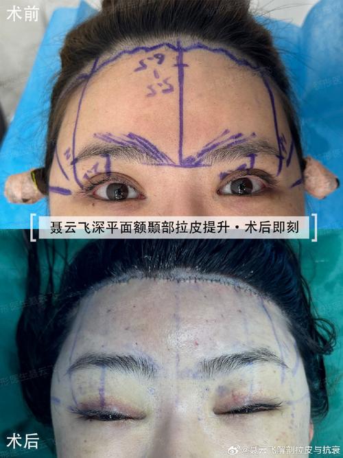 目前最安全的面部提升手术