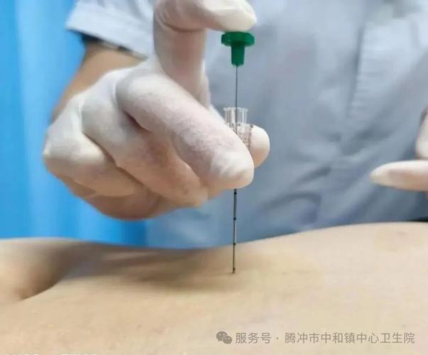 针灸埋线减肥效果如何