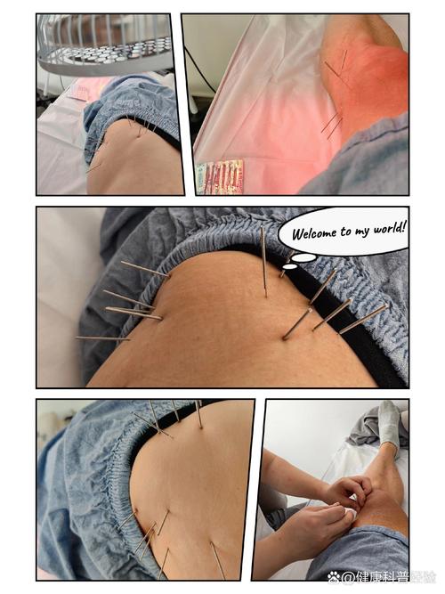 针灸对股骨头坏死疗效