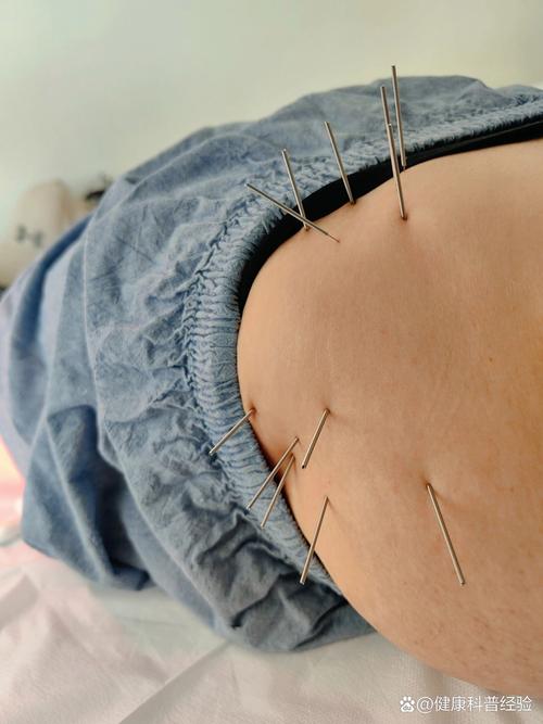 针灸对股骨头坏死疗效