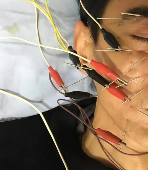 头部神经痛针灸有用吗