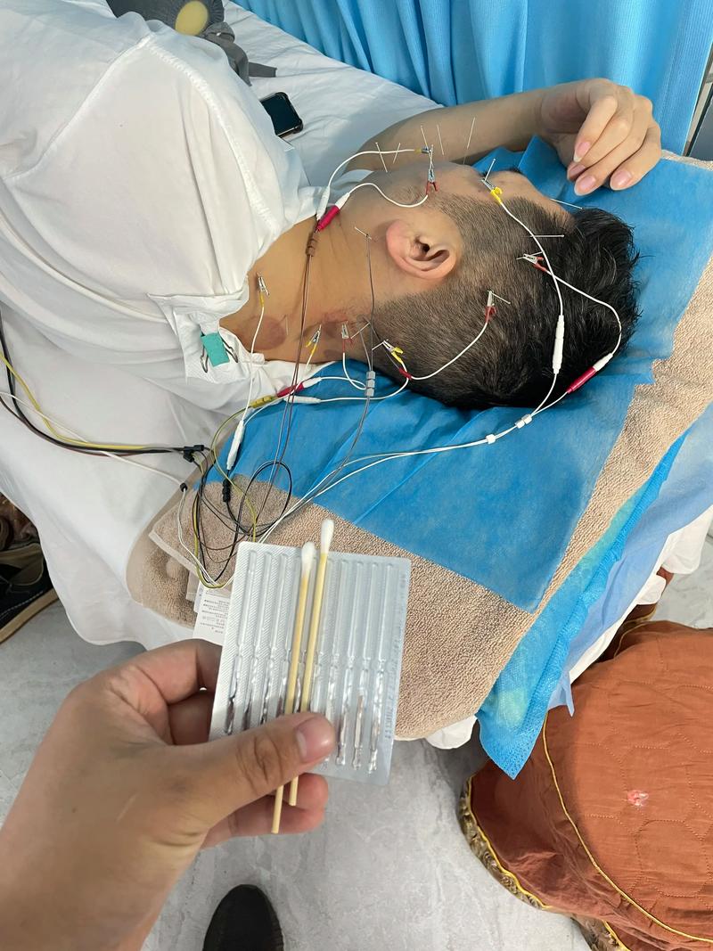 针灸治疗脑膜炎后遗症