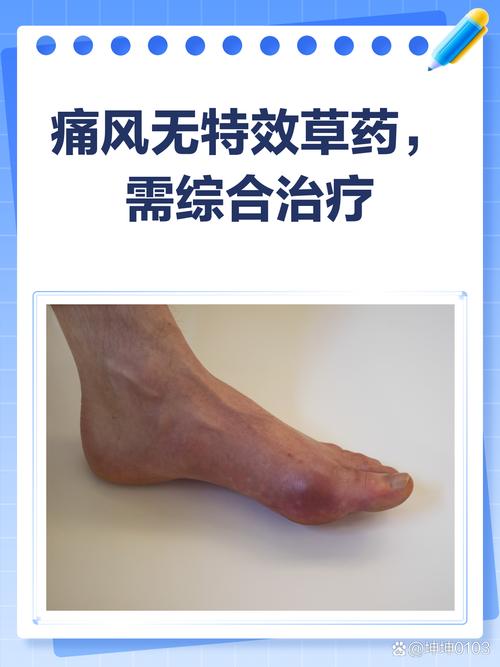 立清酸对痛风有效果吗