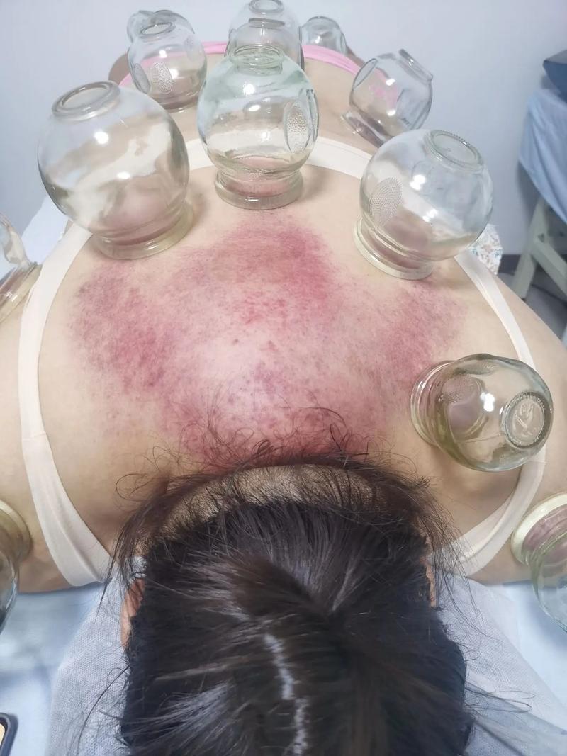 针灸能治淋巴结肿大吗