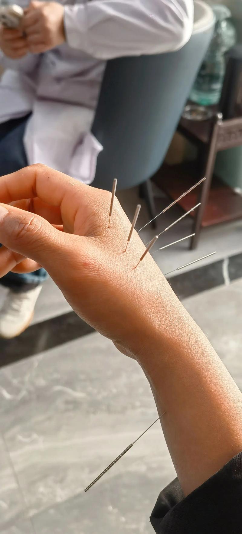 针灸能治风湿关节炎吗