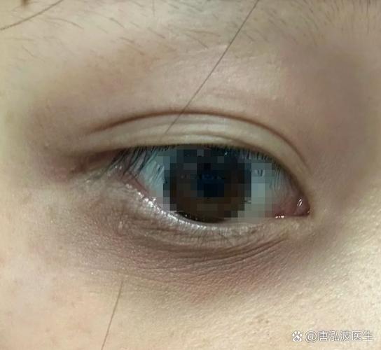 针灸治好了我的黑眼圈