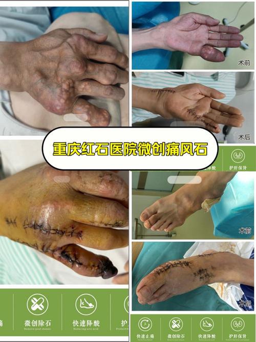 朱建福真的治好痛风么