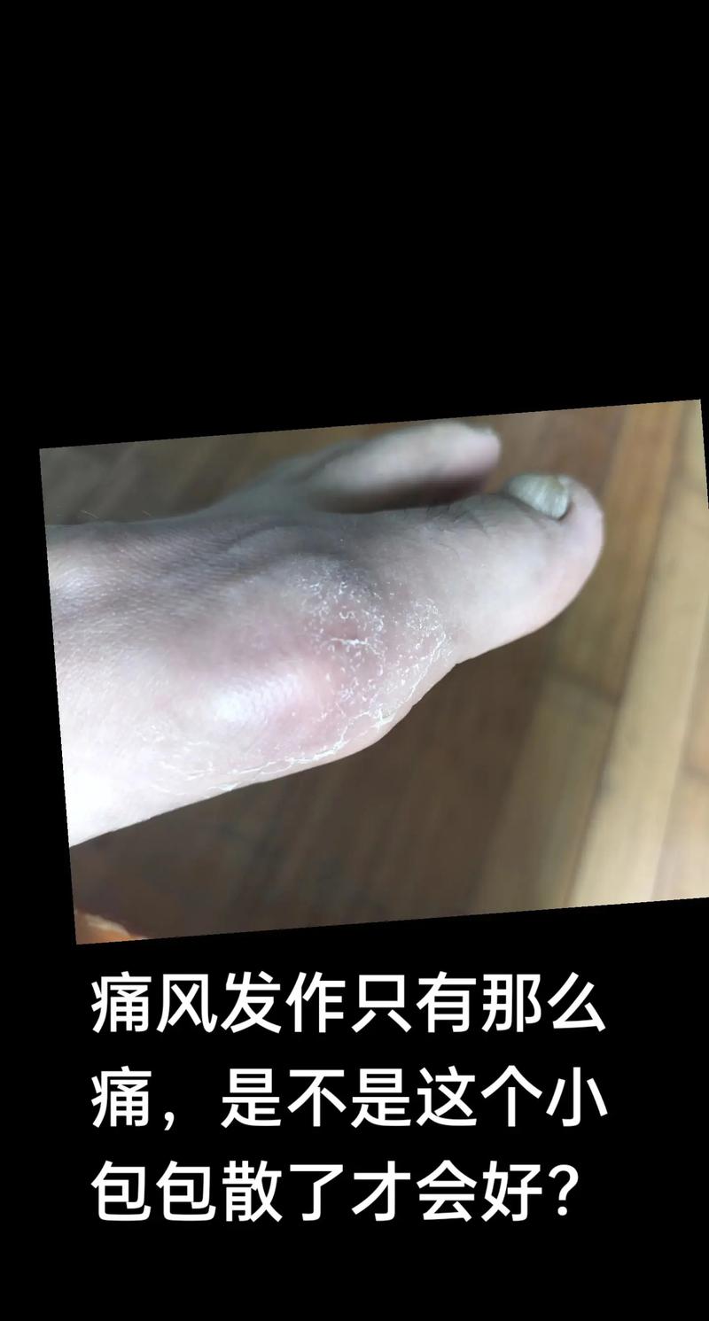 痛风发现的早好治疗吗