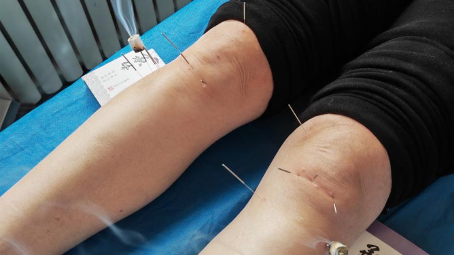 灵枢针灸治疗膝关节痛