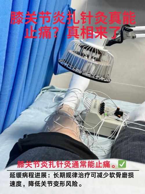 灵枢针灸治疗膝关节痛