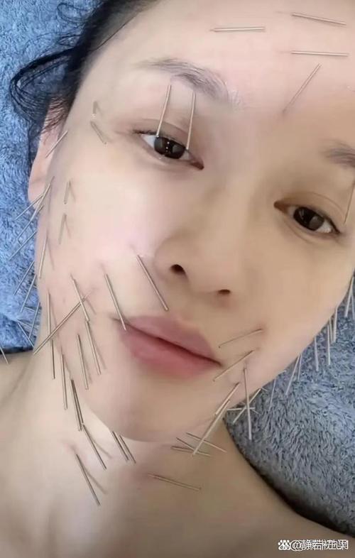 董氏针灸治皮肤瘙痒症