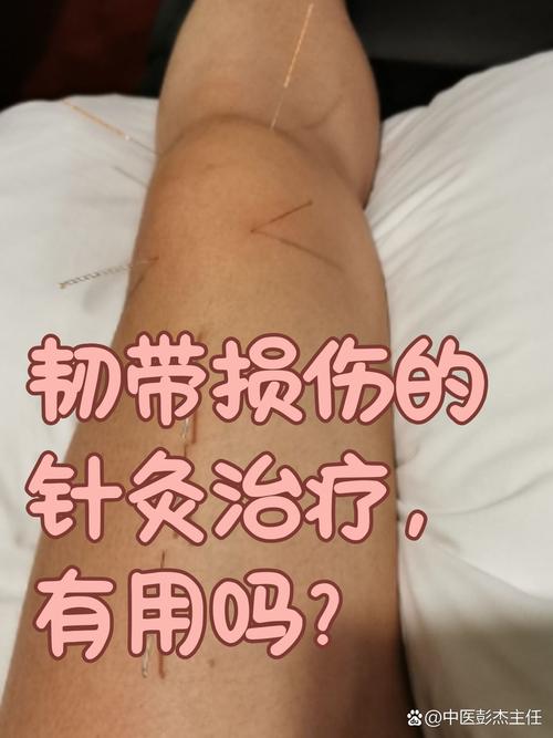 针灸对腰纽伤有效果吗