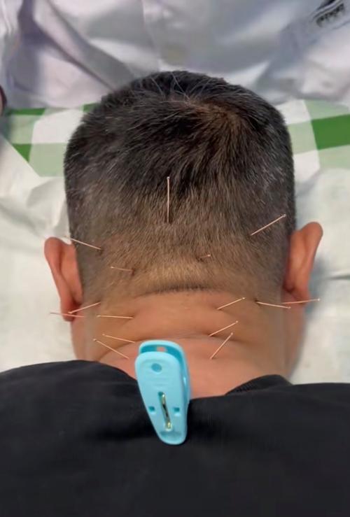 交感神经型颈椎病针灸