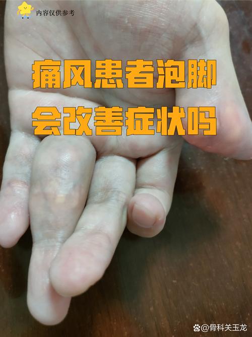 小苏打泡脚能治痛风吗