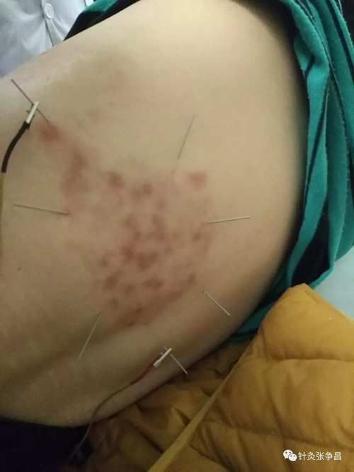 针灸治疗顽固性皮肤病