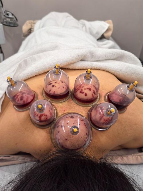 针灸拔罐减肥 中医院