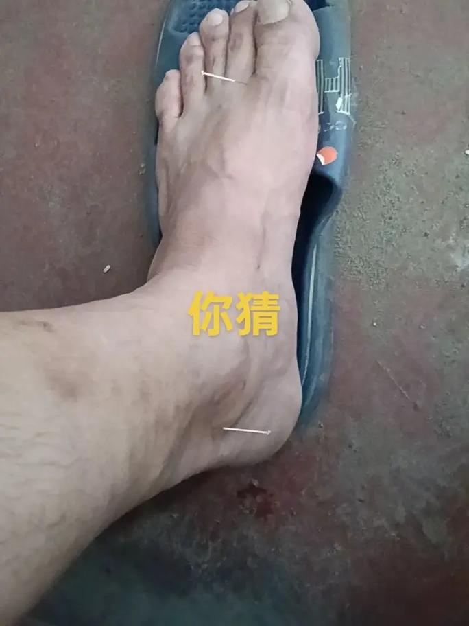 针灸可以治口腔溃疡吗