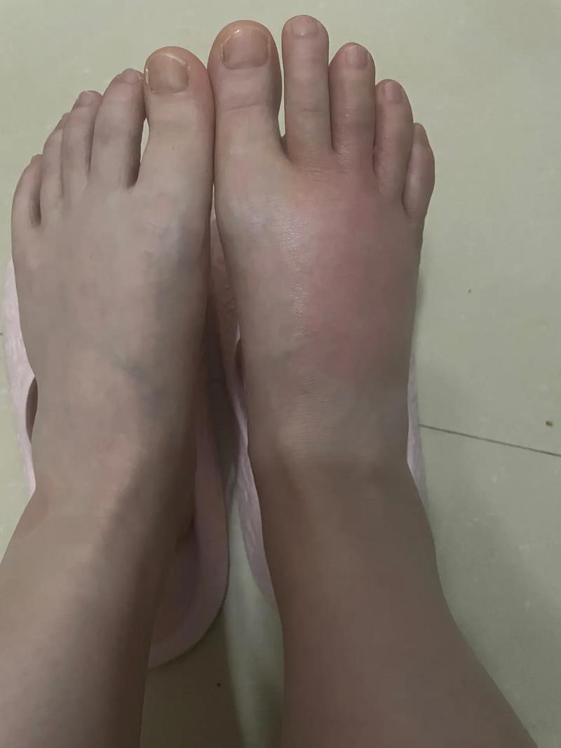 痛风会不会引起脚背肿