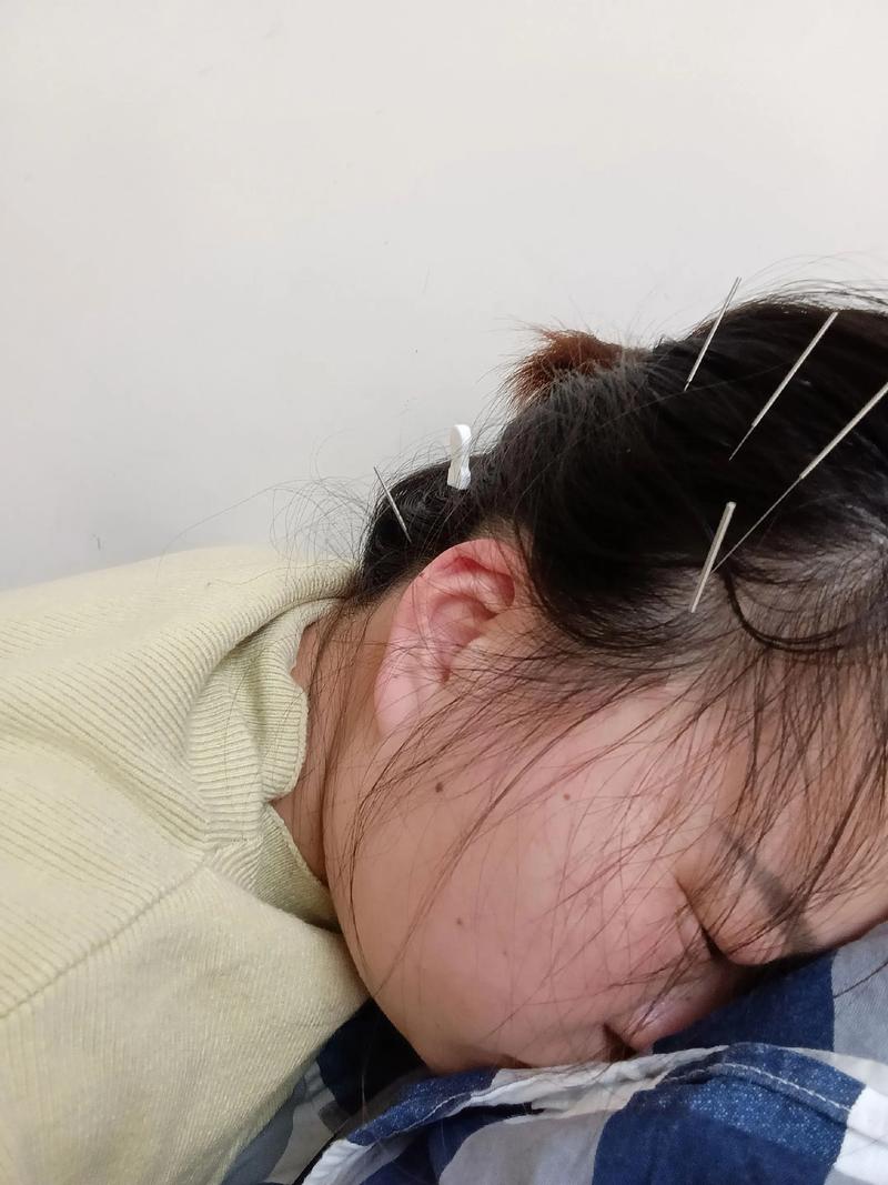 针灸治疗偏头疼有效吗