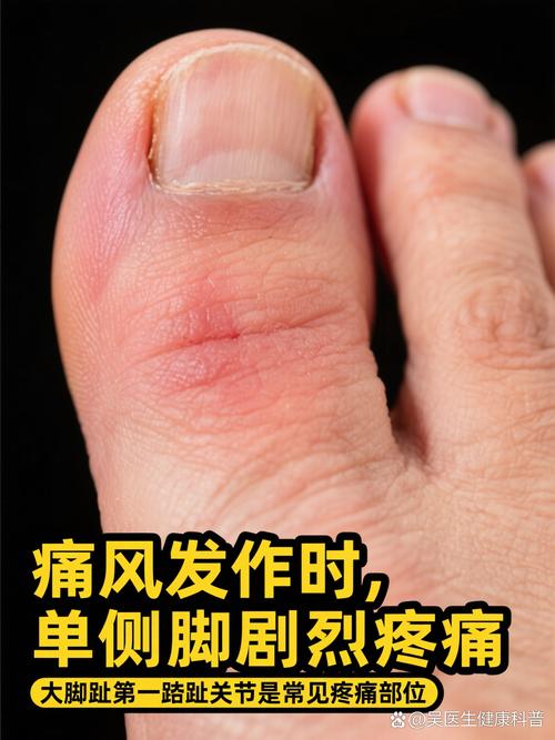 大脚趾有点痛是痛风吗