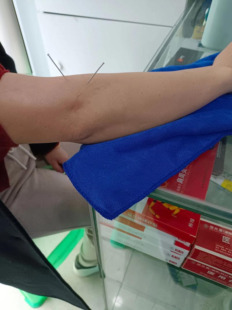 针灸治疗肱骨外上髁炎