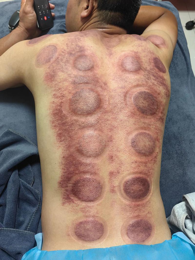 针灸拔罐去失眠哪个好