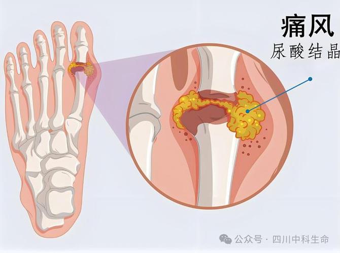 东莞中医院能治痛风吗