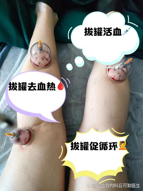 刺血拔罐对痛风有好处