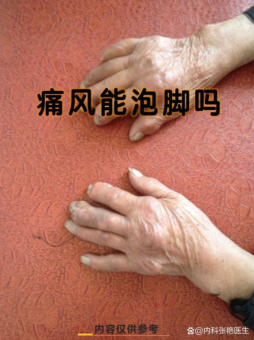 痛风发作期可以足疗吗