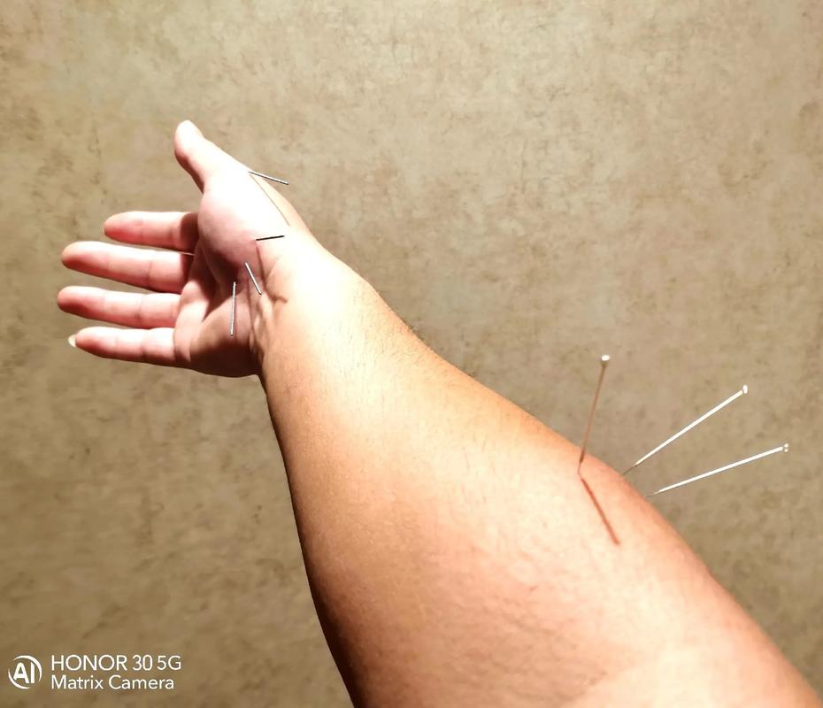 针灸大鱼际治疗打呼噜