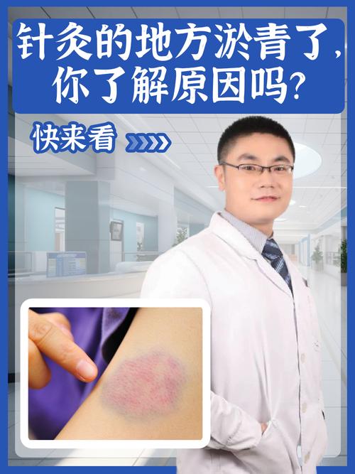 针灸后肿胀怎么回事啊