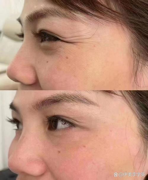 botox祛鱼尾纹安全