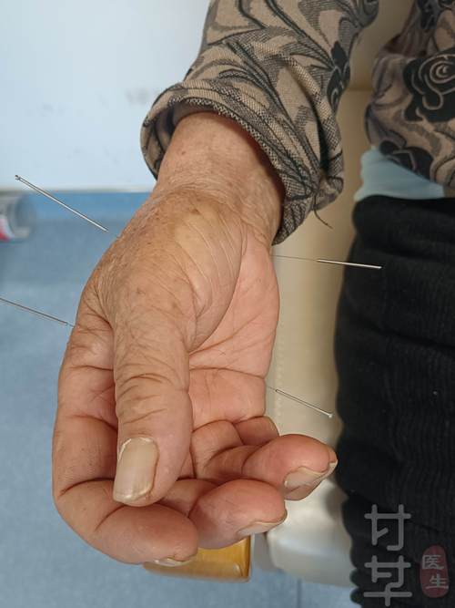 针灸治疗大拇指腱鞘炎