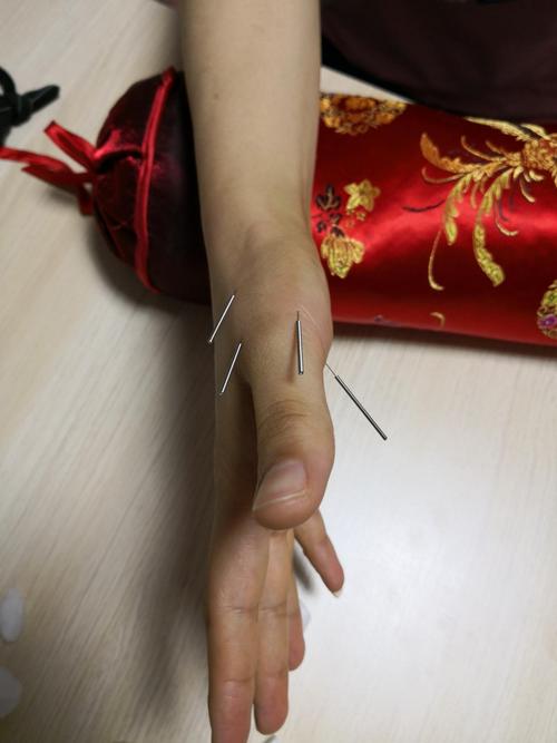 针灸治疗大拇指腱鞘炎