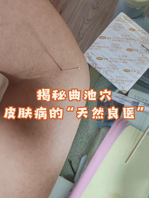 皮肤病可以针灸治疗么