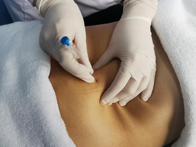 针灸埋线减肥效果好吗