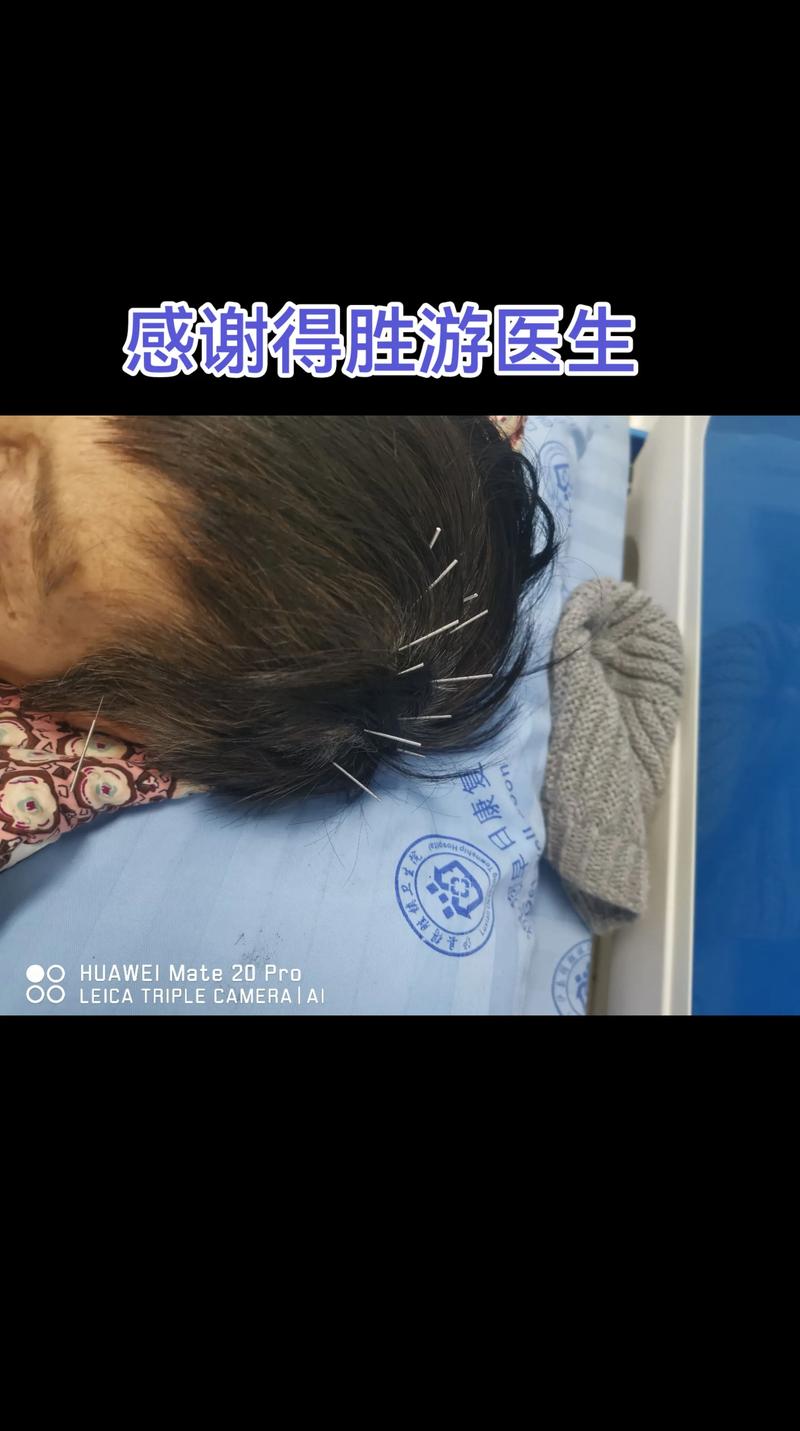 老年人血栓可以针灸吗