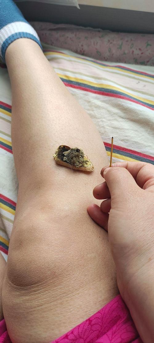 老年人血栓可以针灸吗