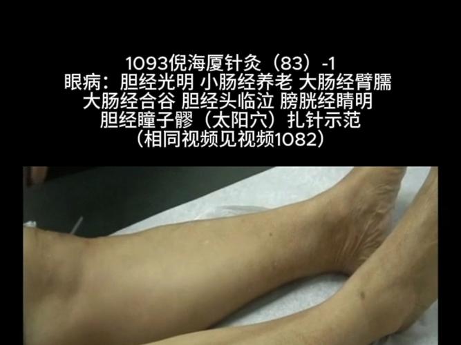 倪海厦治疗针灸下牙痛