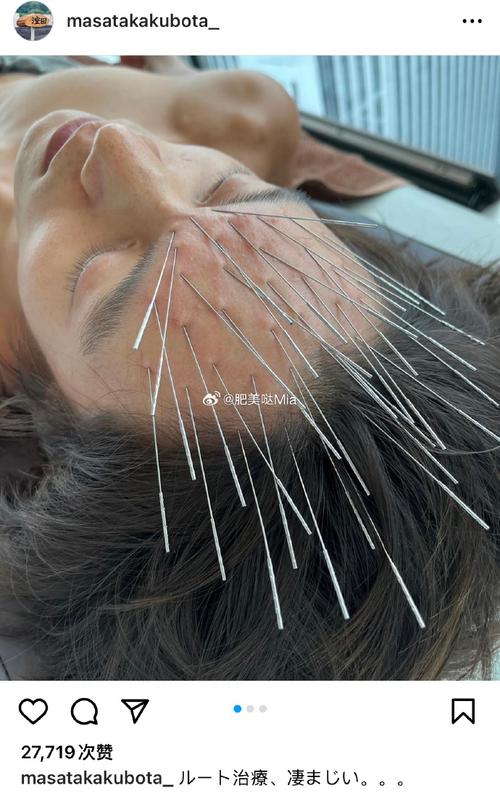 小脑萎缩中医针灸疗法