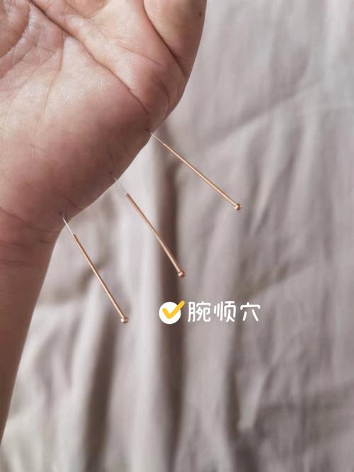 关节腔积液能不能针灸