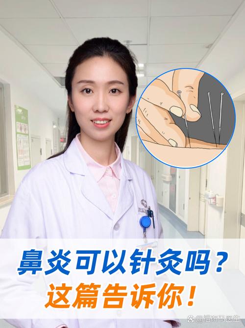 针灸可以治疗鼻窦炎吗