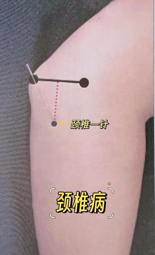 颈椎病针灸多久能治好