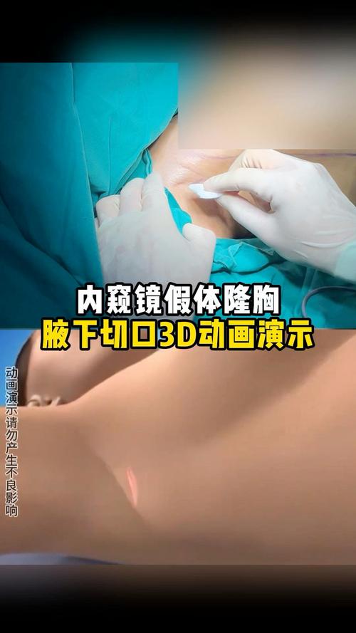 假体隆胸手术安全性如何