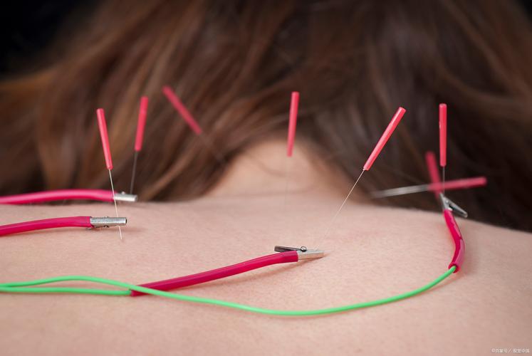 电针和针灸有什么区别