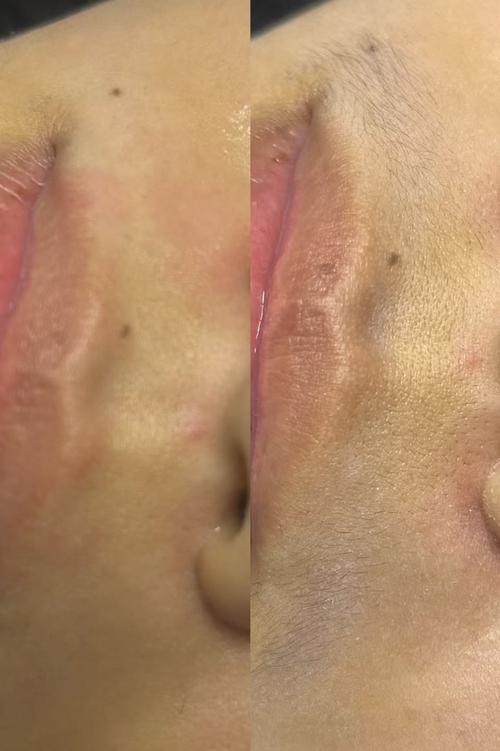 苏州华美冰点脱毛安全么