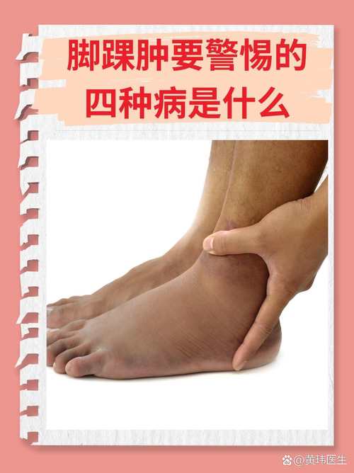 痛风会引起脚踝肿痛吗