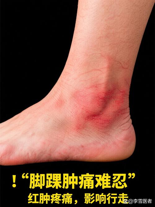 痛风会引起脚踝肿痛吗