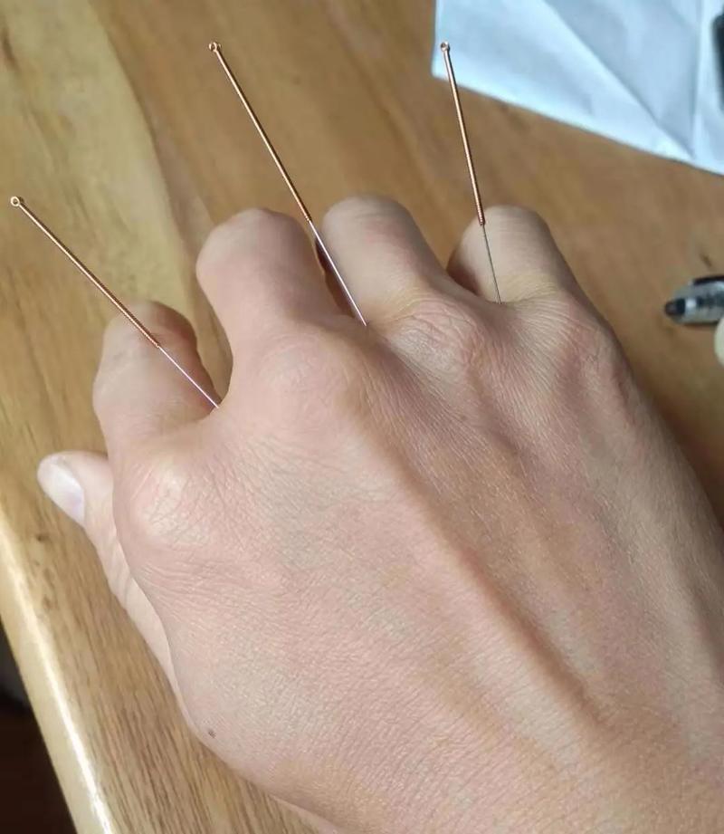 哪里针灸比较好的地方