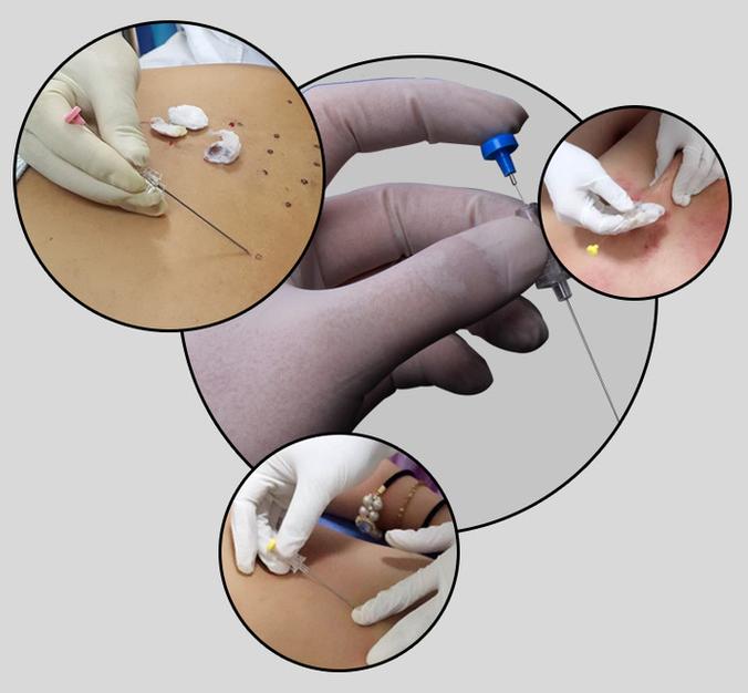 针灸埋线的好处和坏处